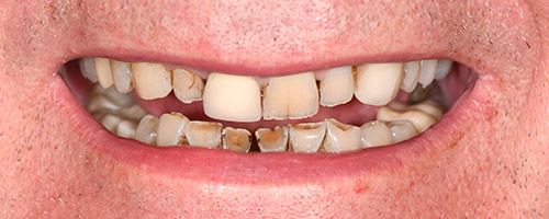 Before After images, Before Image-49 - Walden Dental