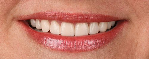 Close Up Smiles After Image 10 - Walden Dental
