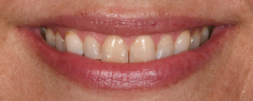 Close Up Smiles Before Image 10 - Walden Dental