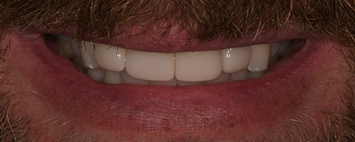 Close Up Smiles After Image 11 - Walden Dental