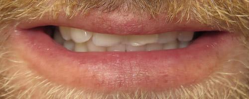 Close Up Smiles Before Image 11 - Walden Dental