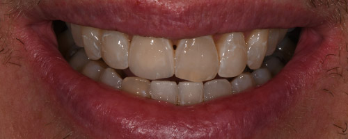 Close Up Smiles After Image 12 - Walden Dental