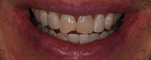 Close Up Smiles Before Image 12 - Walden Dental