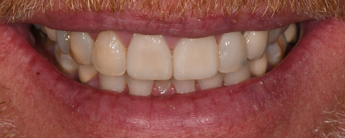 Close Up Smiles After Image 13 - Walden Dental