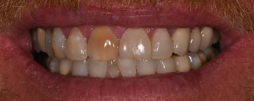 Close Up Smiles Before Image 13 - Walden Dental