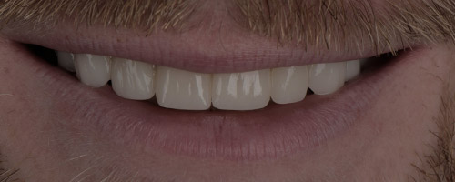 Close Up Smiles After Image 14 - Walden Dental