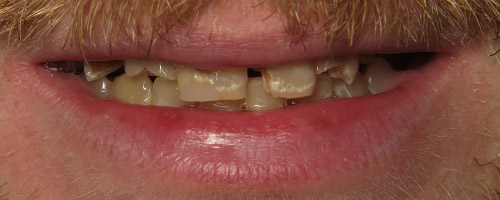 Close Up Smiles Before Image 14 - Walden Dental