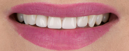 Close Up Smiles After Image 15 - Walden Dental