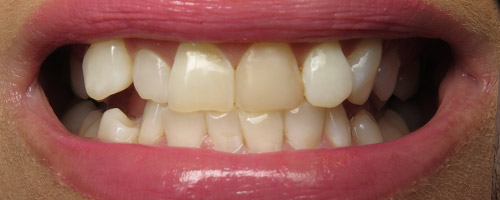 Close Up Smiles Before Image 15 - Walden DentalClose Up Smiles Before Image 15 - Walden Dental