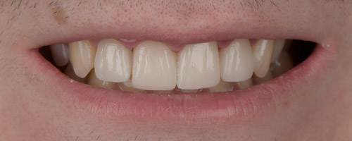 Close Up Smiles After Image 16 - Walden Dental