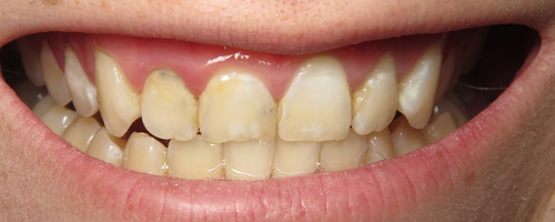 Close Up Smiles Before Image 16 - Walden Dental