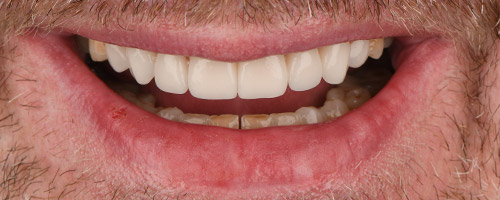 Close Up Smiles After Image 17 - Walden Dental