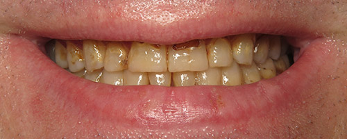 Close Up Smiles Before Image 17 - Walden Dental