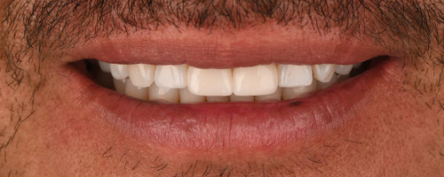 Close Up Smiles After Image 18 - Walden Dental