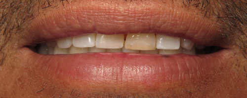 Close Up Smiles Before Image 18 - Walden Dental