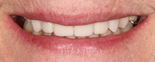 Close Up Smiles After Image 19 - Walden Dental