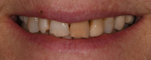 Close Up Smiles Before Image 19 - Walden Dental