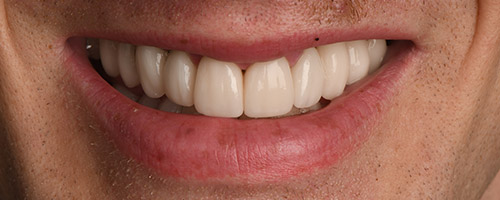 Close Up Smiles After Image 2 - Walden Dental