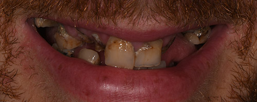 Close Up Smiles Before Image 2 - Walden Dental