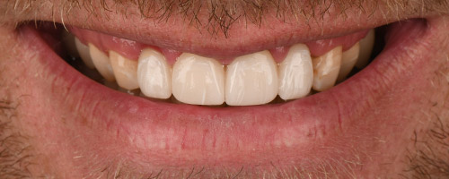 Close Up Smiles After Image 20 - Walden Dental