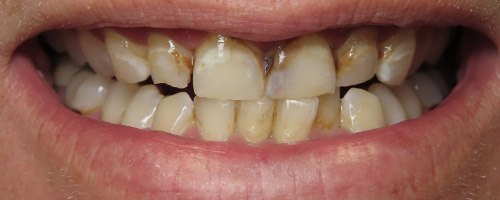 Close Up Smiles Before Image 20 - Walden Dental