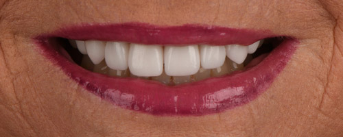 Close Up Smiles After Image 21 - Walden Dental