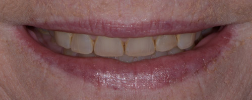 Close Up Smiles Before Image 21 - Walden Dental