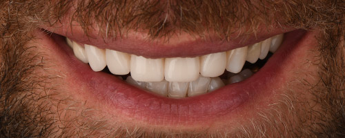 Close Up Smiles After Image 22 - Walden Dental