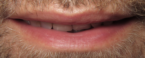 Close Up Smiles Before Image 22 - Walden Dental