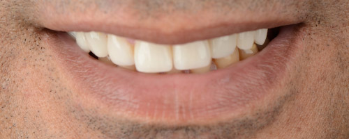 Close Up Smiles After Image 23 - Walden Dental