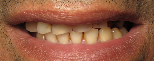 Close Up Smiles Before Image 23 - Walden Dental