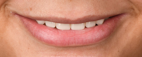 Close Up Smiles After Image 23 - Walden Dental