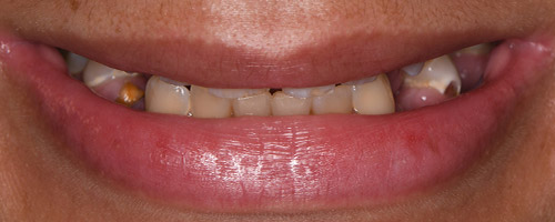 Close Up Smiles Before Image 23 - Walden Dental