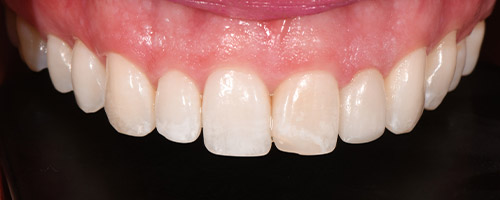Close Up Smiles After Image 25 - Walden Dental