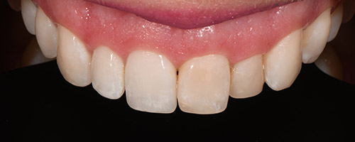 Close Up Smiles Before Image 25 - Walden Dental