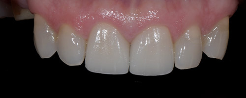 Close Up Smiles After Image 26 - Walden Dental