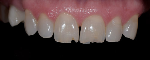 Close Up Smiles Before Image 26 - Walden Dental
