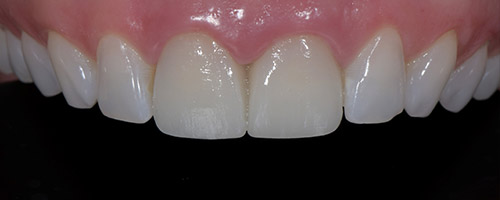 Close Up Smiles After Image 27 - Walden Dental