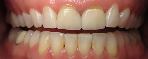 Close Up Smiles Before Image 27 - Walden Dental