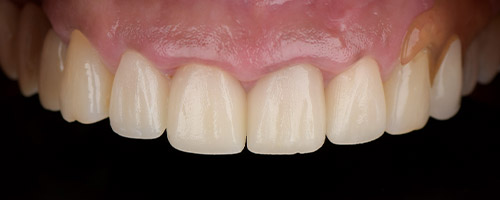 Close Up Smiles After Image 28 - Walden Dental