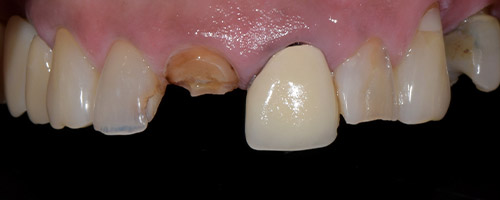 Close Up Smiles Before Image 28 - Walden Dental