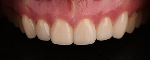 Close Up Smiles After Image 29 - Walden Dental