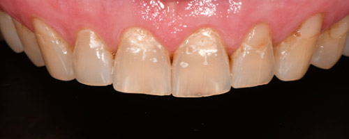 Close Up Smiles Before Image 29 - Walden Dental