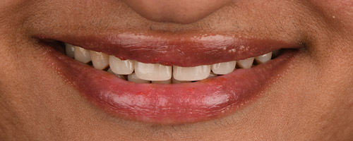 Close Up Smiles After Image 3 - Walden Dental