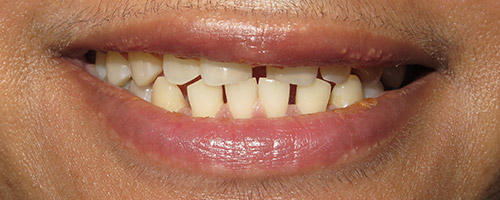 Close Up Smiles Before Image 3 - Walden Dental