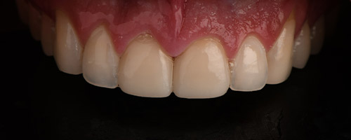 Close Up Smiles After Image 30 - Walden Dental