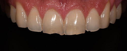 Close Up Smiles Before Image 30 - Walden Dental