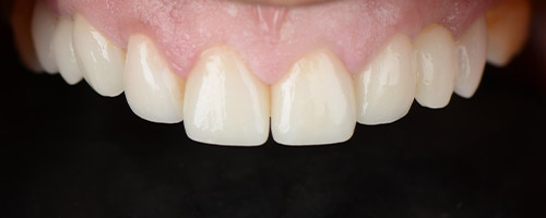 Close Up Smiles After Image 31 - Walden Dental