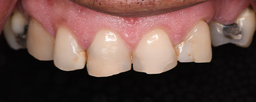 Close Up Smiles Before Image 31 - Walden Dental