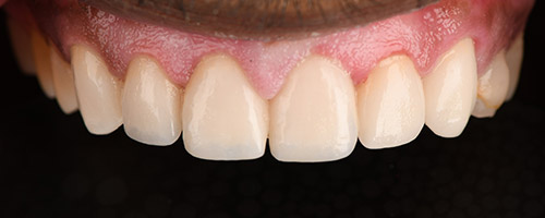 Close Up Smiles After Image 32 - Walden Dental